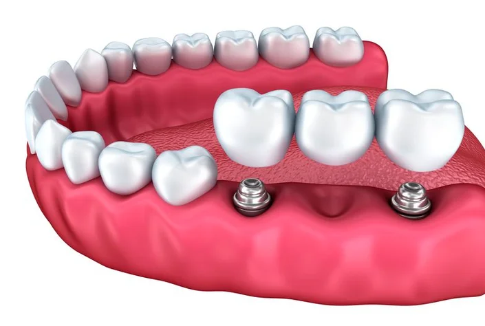 Odontología Especializada Cristian Botina | Estética Dental en Mocoa