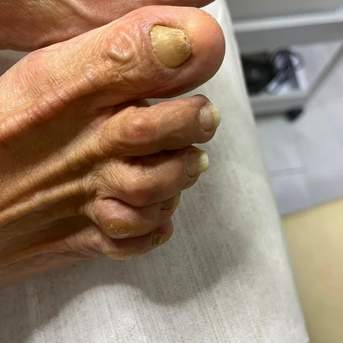 Pie de angel podologia
